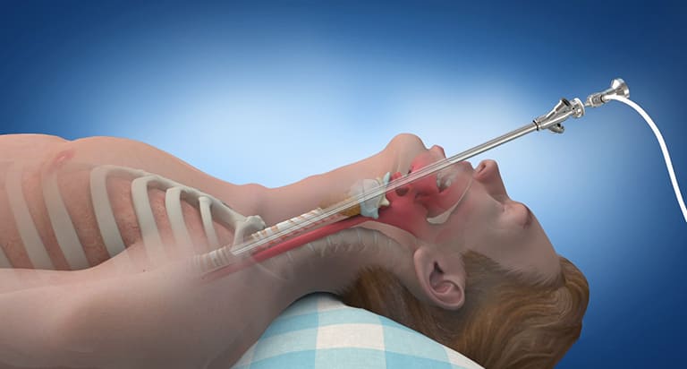 endobronchial-ultrasound-treatmentn