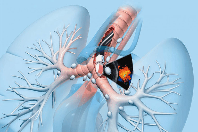 endobronchial-ultrasound-treatmentn