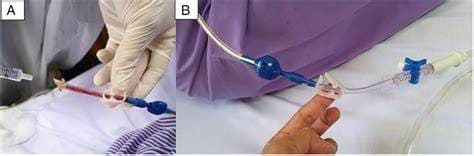 endobronchial-ultrasound-treatmentn