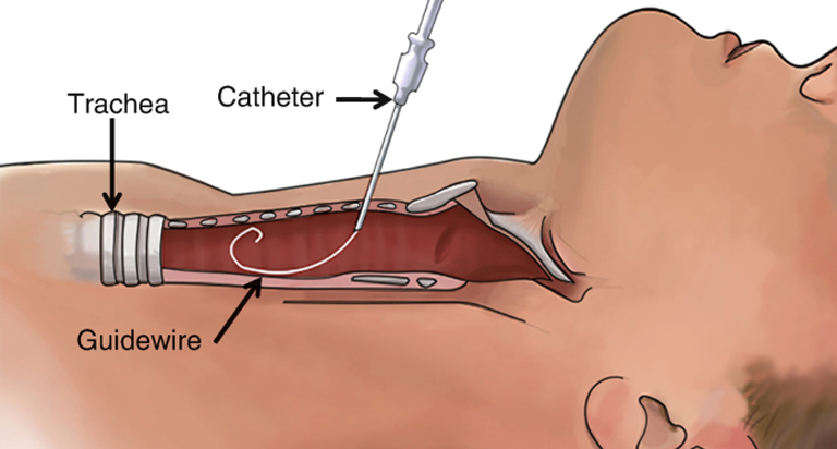 endobronchial-ultrasound-treatmentn