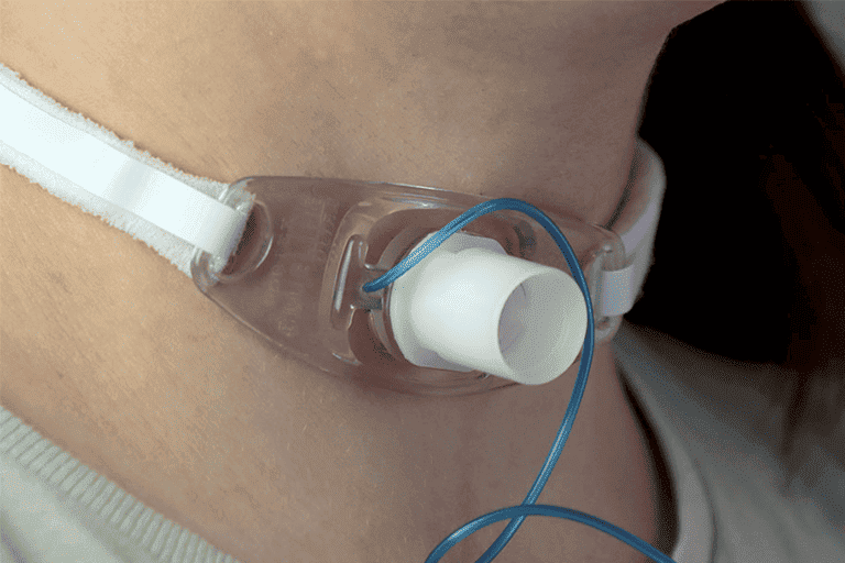 tracheostomy