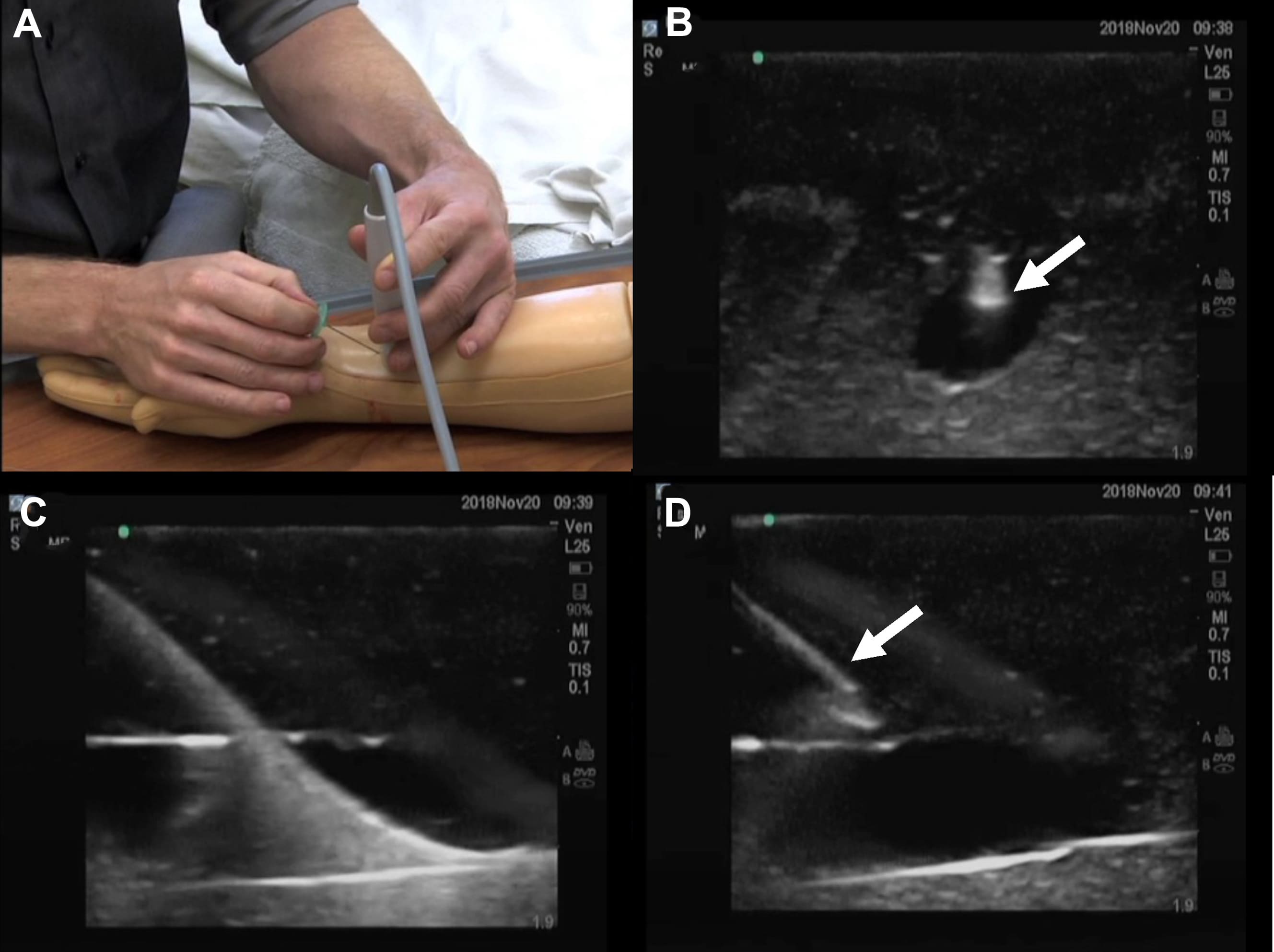 endobronchial-ultrasound-treatmentn