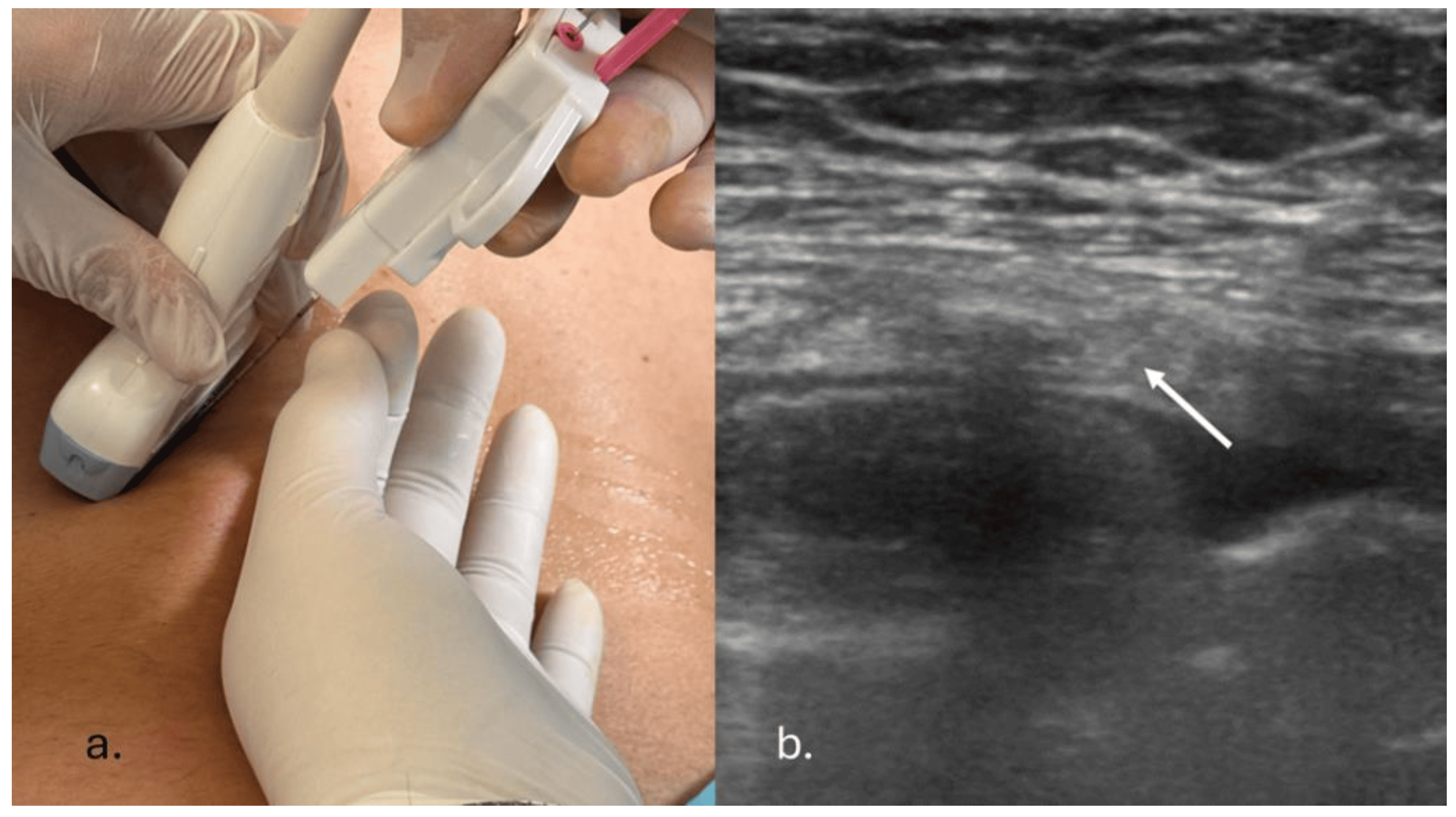 endobronchial-ultrasound-treatmentn