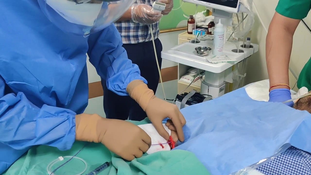 endobronchial-ultrasound-treatmentn