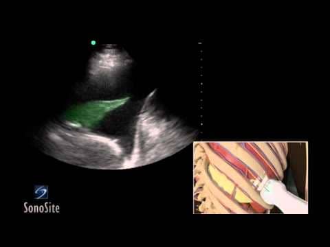 endobronchial-ultrasound-treatmentn