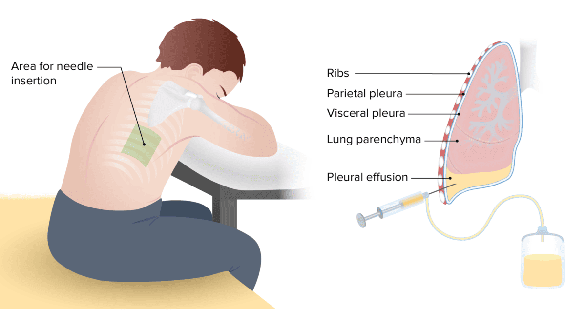 lung-ultrasound-treatmen