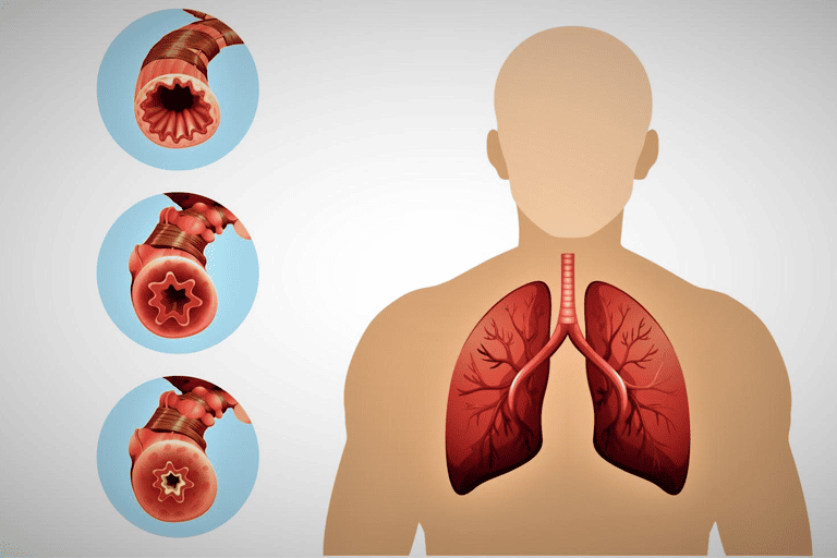 Bronchitis