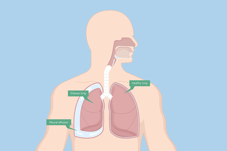 Pleural Effusion