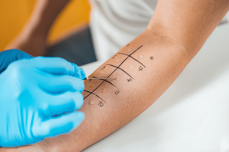 Skin Prick Test